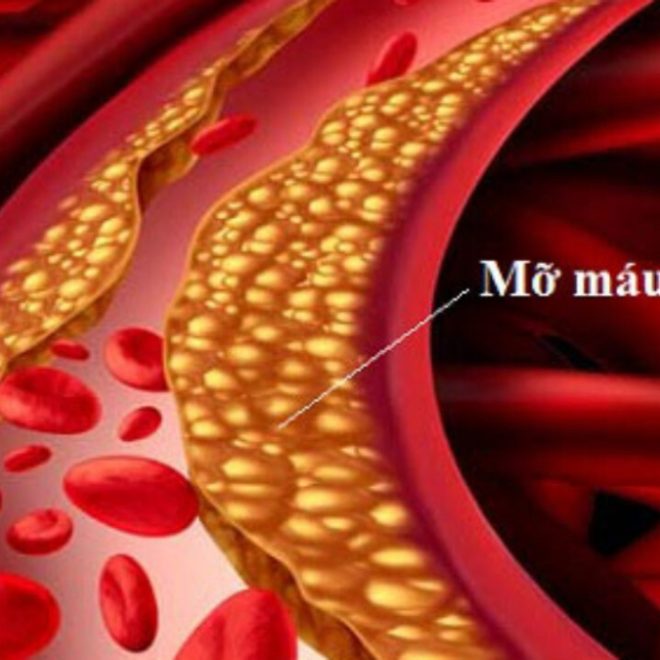Rối loạn mỡ máu
