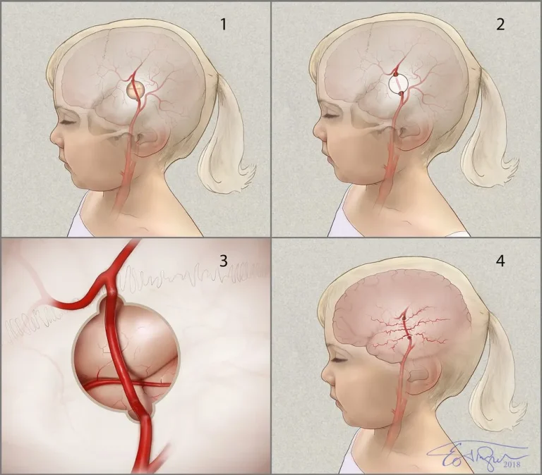 🧠 Các dấu hiệu của bệnh Moyamoya (chi tiết)