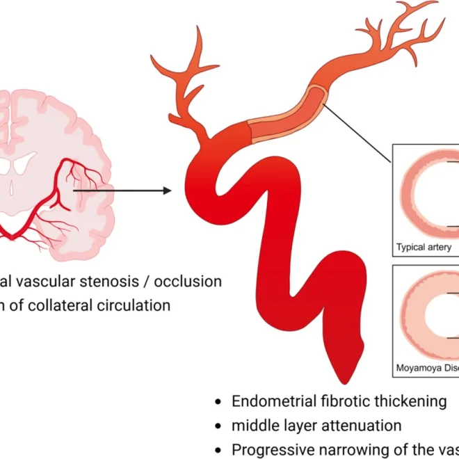 🧠Bệnh Moyamoya: Giải thích chi tiết