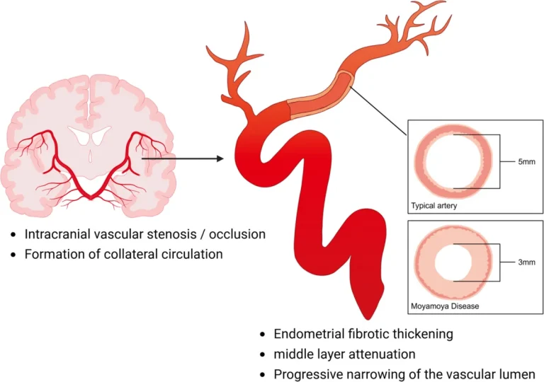 🧠Bệnh Moyamoya: Giải thích chi tiết
